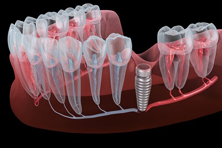 Illustration of implant placed in gum tissue