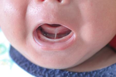 Close-up view of baby’s tongue tie