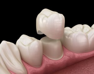 Rendering of dental crown fitting over a tooth. 
